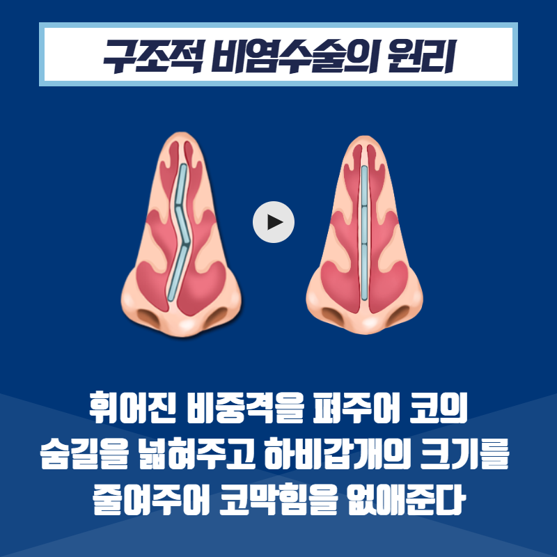 [비염치료] 비염 수술을 해야 하는 이유 (4/12)