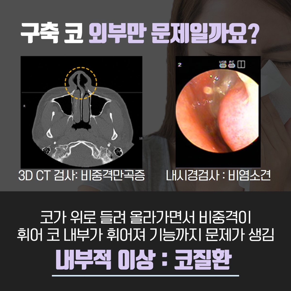 구축코 재수술, 더 이상의 코 수술은 그만! 구축코 협진으로! (5/13)