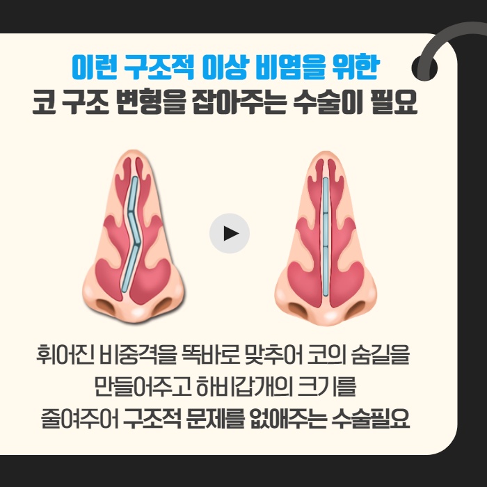 [수원 이비인후과] 콧물이 나는 이유 감기가 아닐 수도. (7/14)