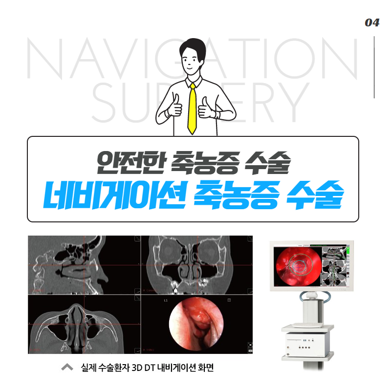 축농증(부비동염)은 왜 생길까? 원인과 치료! (5/8)
