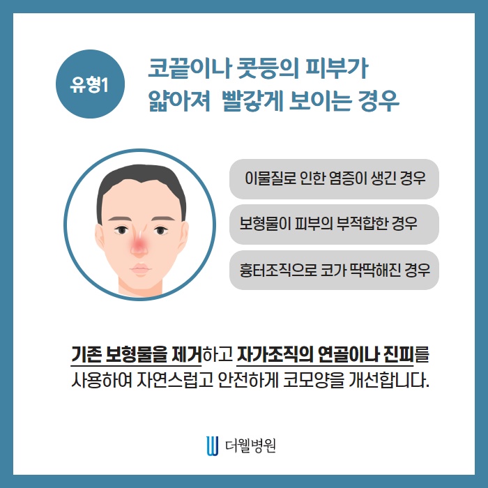 유형별 코재수술 (3/10)