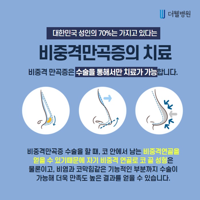 비중격만곡증, 수술로만 치료가 가능할까? (3/11)