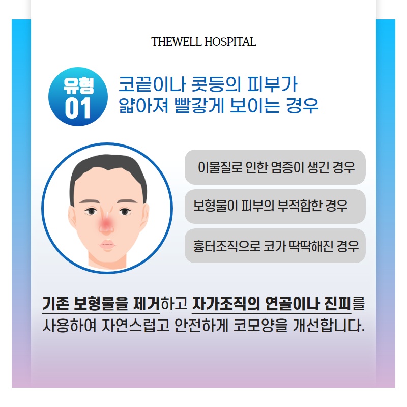 다양한 유형의 코 재수술, 더웰병원에서 하자! (3/10)