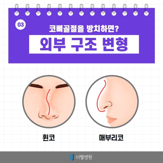 코 뼈 골절은 치료시기가 중요해요! (4/10)
