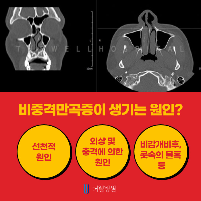 휜 코 성형, 질환까지 개선하자! (3/10)