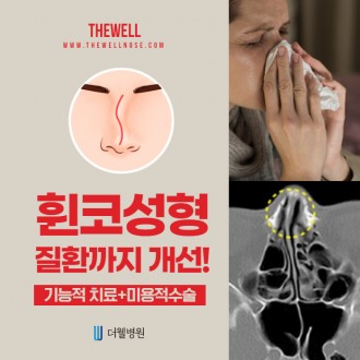 휜 코 성형, 질환까지 개선하자!