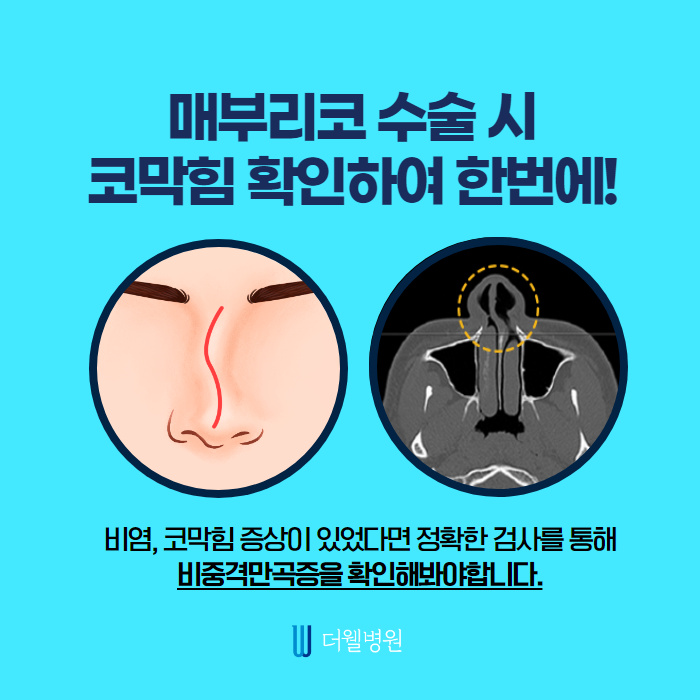 매부리코! 질환도 함께 개선하면 일석이조! (4/10)