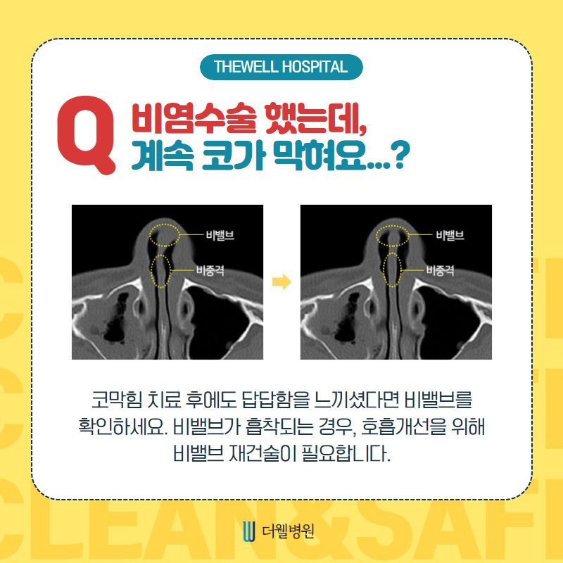 코수술 모든 궁금증 해결해드립니다! (4/9)