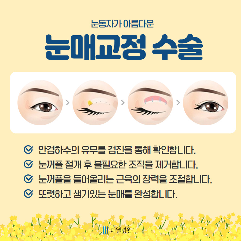 안검하수, 쌍꺼풀이 아닌 눈매교정으로 개선하세요! (4/10)
