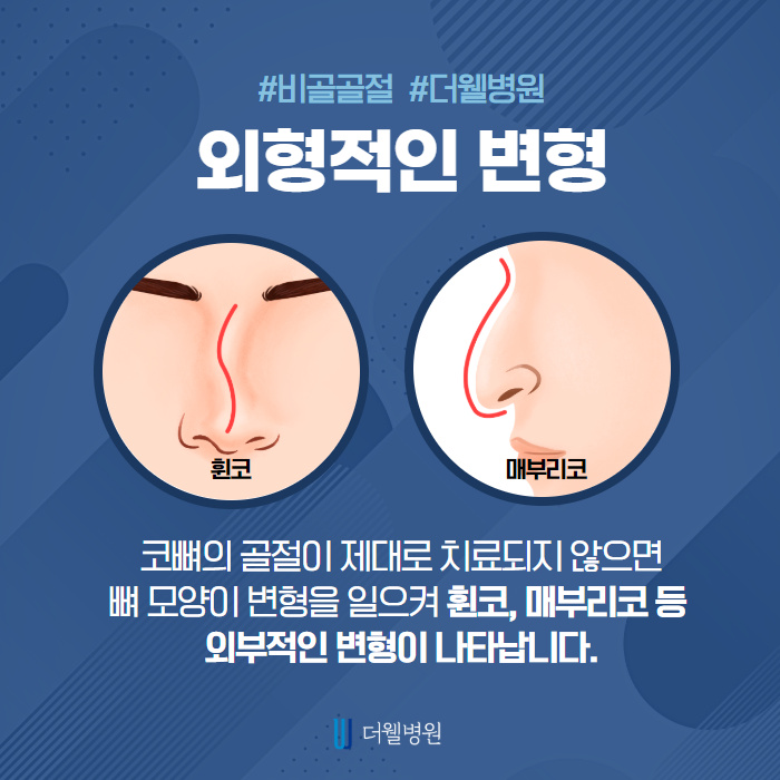 코 뼈가 부러졌다면 신속하게 치료! (4/10)