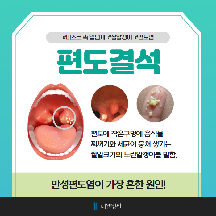 마스크 속 입냄새의 원인 편도결석 빼는 방법! (2/11)