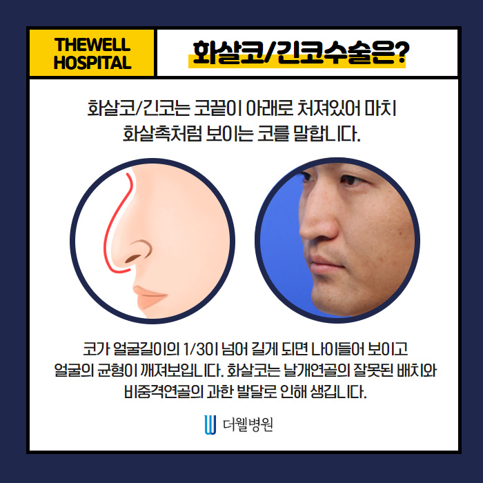 화살코/긴 코 솔루션!! (3/10)