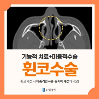 휜 코 개선할 때 비중격만곡증 동시에 개선하세요~
