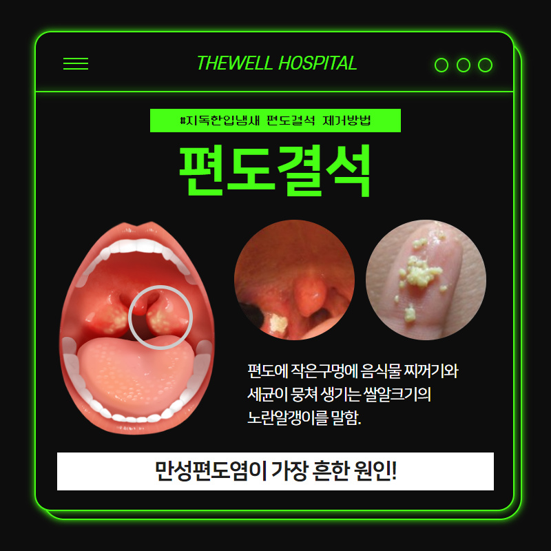 지독한 입냄새, 마스크 속 입냄새의 원인! 편도결석 제거방법! (2/10)