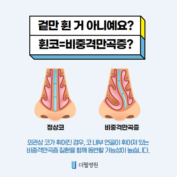 휜코 성형 시 비중격만곡증 동시에 개선!! (2/10)