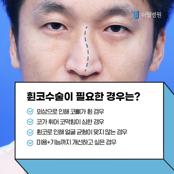 휜코 성형 시 비중격만곡증 동시에 개선!! (4/10)