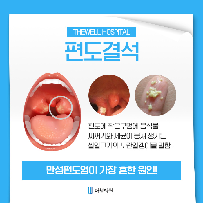 시원하게 편도결석 제거하세요! (2/11)