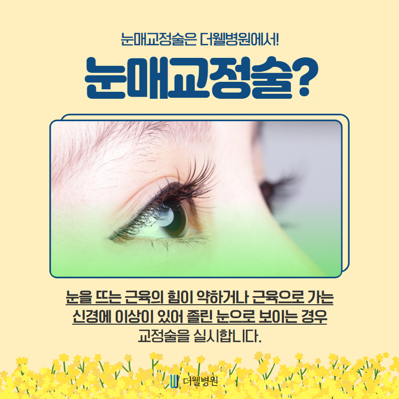 더웰병원 눈매교정술