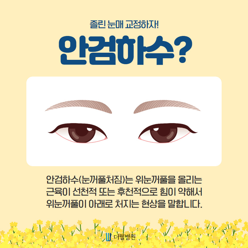 더웰병원 눈매교정술