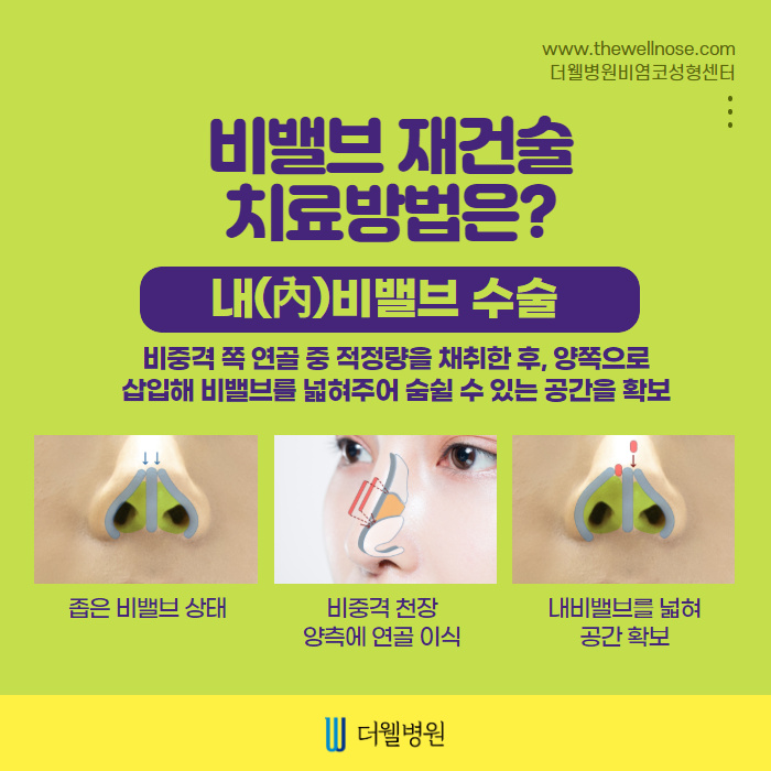 더웰병원 비밸브재건술