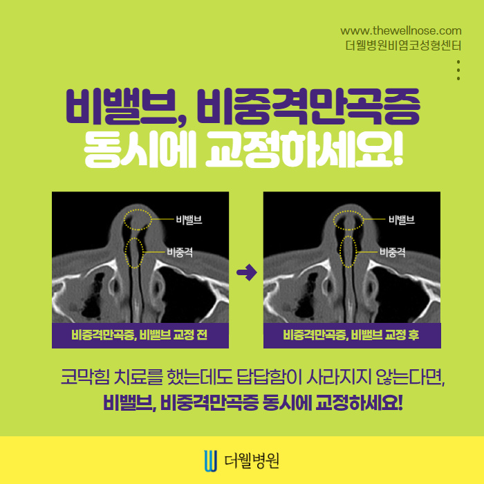 더웰병원 비밸브재건술