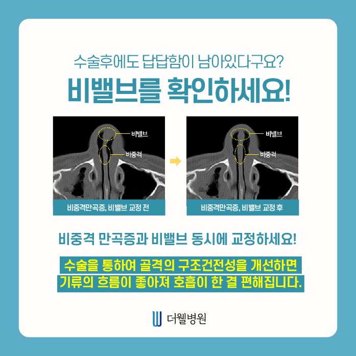 더웰병원 비중격만곡증 수술