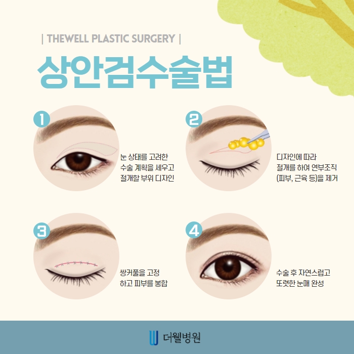 더웰병원 상안검 수술