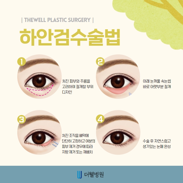 더웰병원 상안검 수술