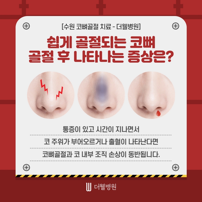 더웰병원 코뼈골절 수술