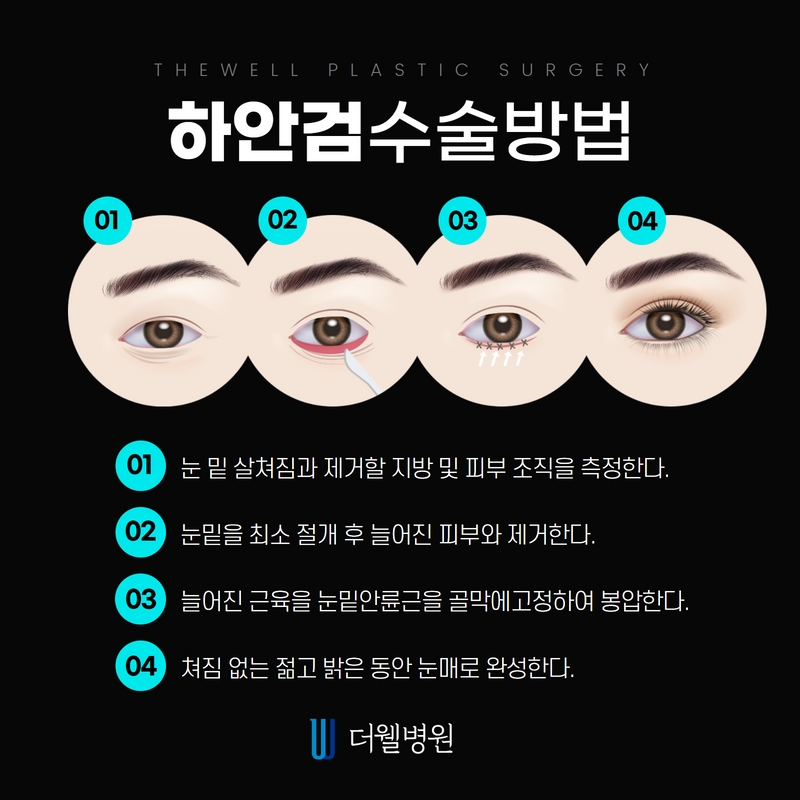 더웰병원 하안검 수술